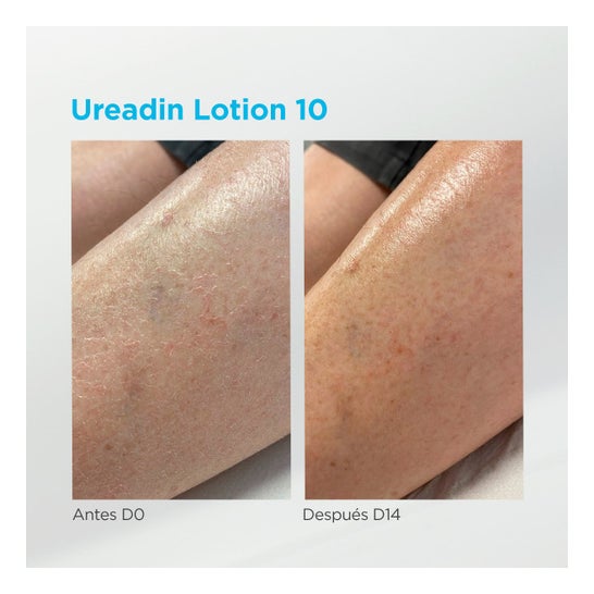 ISDIN®  Ureadin®  Hydration  lotion 10% urea 1l