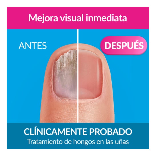 Excilor Forte Color Tratamiento de Hongos de Uñas Nude 30ml