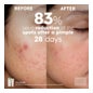 Martiderm® Acniover Cicavent Anti-imperfecciones 40ml