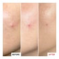 Erborian Centella SOS Patch 10% PHA 9ml